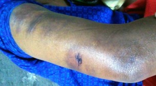 বোরহানউদ্দিনে ভাই’র স্ত্রীকে জখম  করে পাল্টা হুমকির অভিযোগ