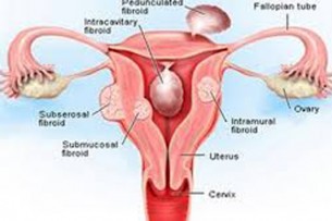 মনপুরাতে জরায়ু ক্যান্সার টেস্ট কার্যক্রম শুরু