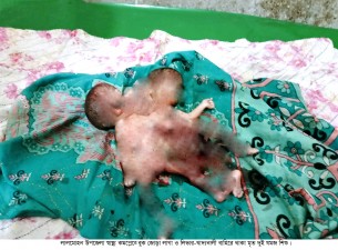 লালমোহনে বুক জোড়া লাগা দুই যমজ শিশুর জন্ম
