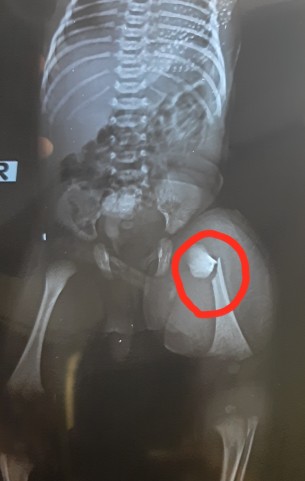 চরফ্যাসনে নবজাতকের পা ভাঙ্গার অভিযোগে  চিকিৎসকের বিরুদ্ধে তদন্ত কমিটি গঠন