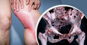 সাধারণ পায়ের ব্যথাও হতে পারে ক্যানসারের লক্ষণ