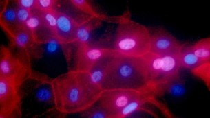 ক্যান্সার শনাক্ত এবং চিকিৎসায় নয়া প্রযুক্তি