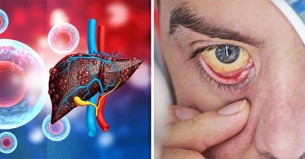 অজান্তেই লিভার নষ্ট করে দেয় ‘হেপাটাইটিস বি’, জানুন লক্ষণ