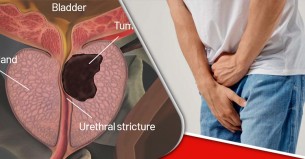 রাতে প্রস্রাবের চাপে ঘুম ভাঙে, প্রোস্টেট ক্যানসারের লক্ষণ নয় তো?