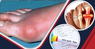ওষুধ ছাড়াই ইউরিক অ্যাসিড বশে আনার ৩ উপায়