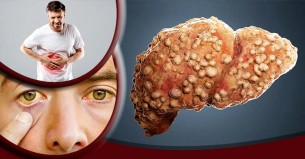 লিভার সিরোসিসের ৫ লক্ষণ অবহেলা করলেই বিপদ