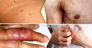 ডায়াবেটিস রোগীর ত্বকে গুরুতর যে ১০ লক্ষণ দেখা দেয়