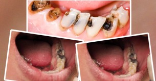 দাঁতের ক্যাভিটি থেকে মুক্তির ৫ উপায়