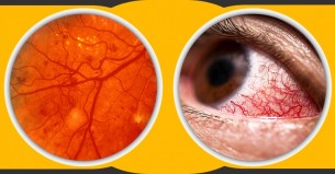 ডায়াবেটিসের গুরুতর যে লক্ষণ ফুটে ওঠে চোখে