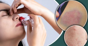 প্লাটিলেট কমতে শুরু করলে যে লক্ষণ দেখা দেয় শরীরে