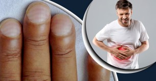 ফ্যাটি লিভারের যে লক্ষণ দেখা দেয় হাতে