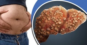 হঠাৎ ভুঁড়ি বেড়ে যাচ্ছে, লিভার সিরোসিসের লক্ষণ নয় তো?