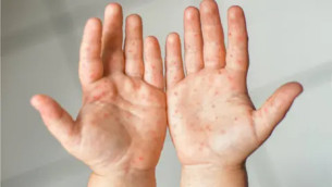 হাম ও উপসর্গে আরও ৪ শিশুর মৃত্যু