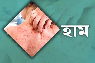 ২৪ ঘণ্টায় হাম ও হামের উপসর্গে ৯ জনের মৃত্যু