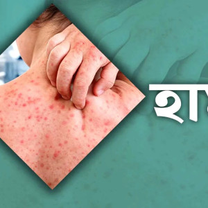 ২৪ ঘণ্টায় হাম ও হামের উপসর্গে ৯ জনের মৃত্যু